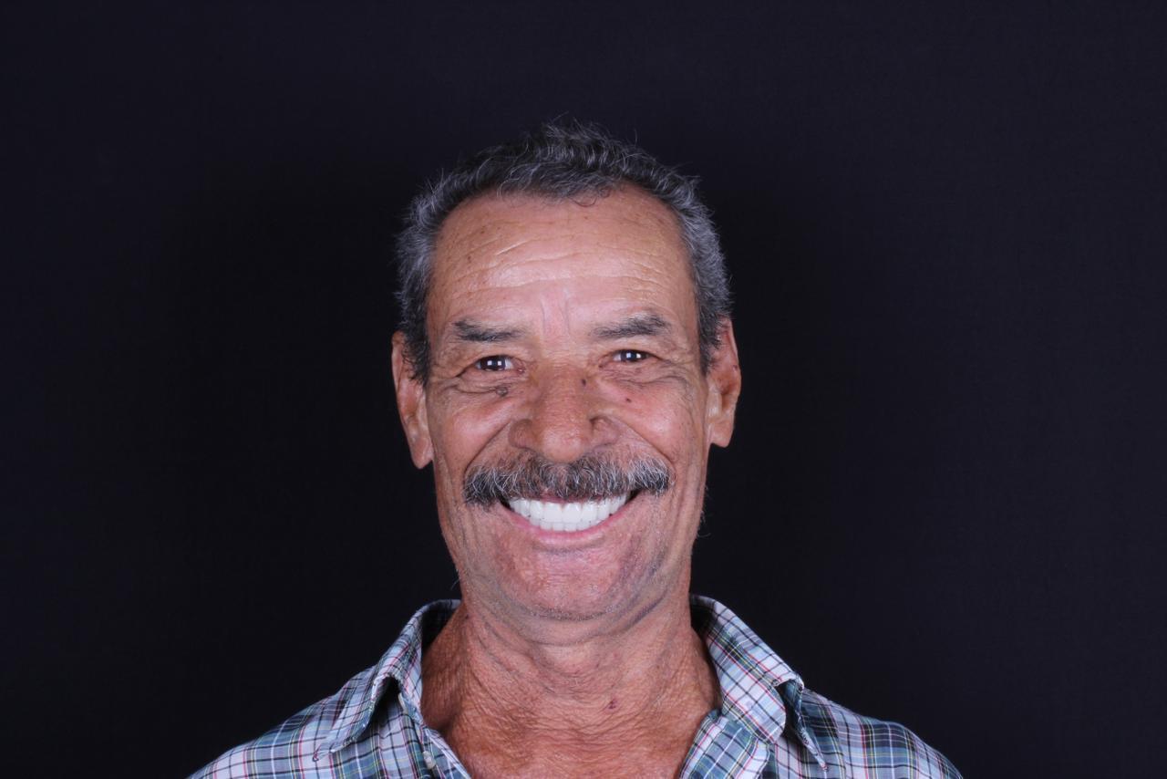 Dentes Novos - Depois